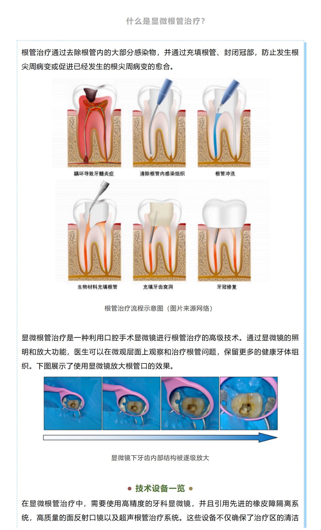 口腔诊疗“黑科技”丨牙科手术显微镜助力根管治疗_01.png