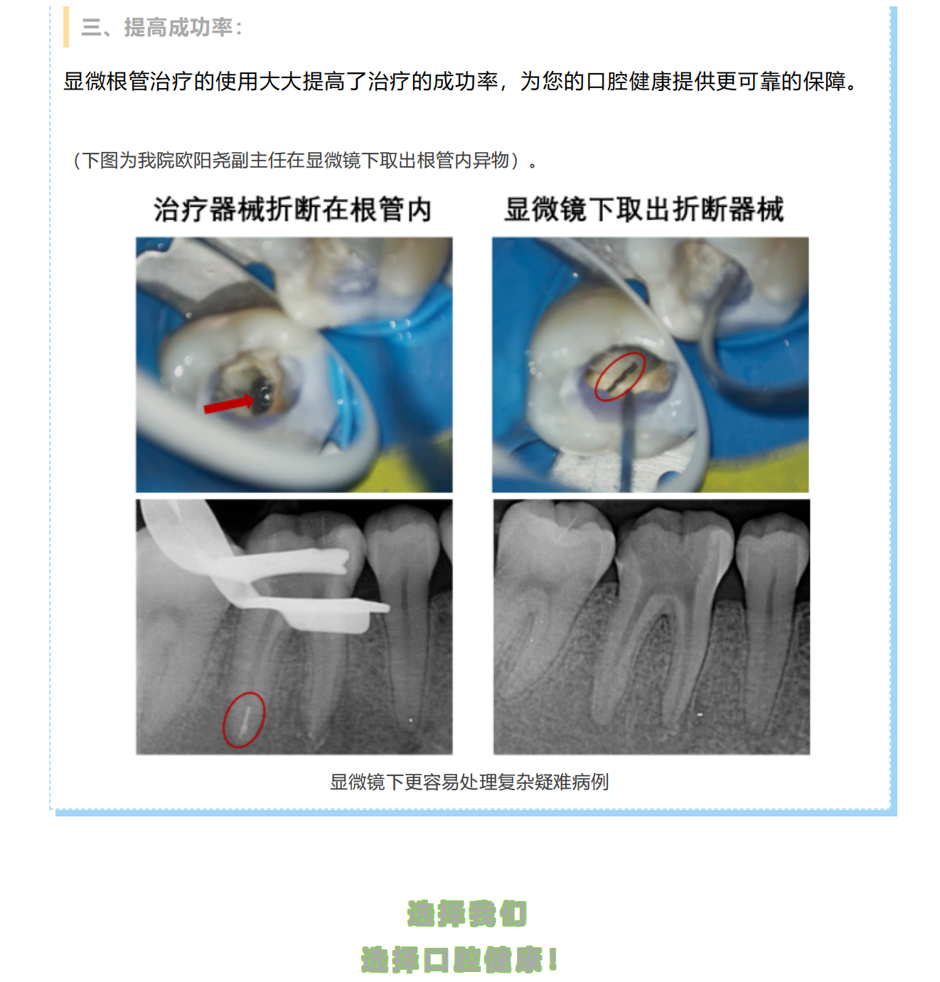 口腔诊疗“黑科技”丨牙科手术显微镜助力根管治疗_03.png